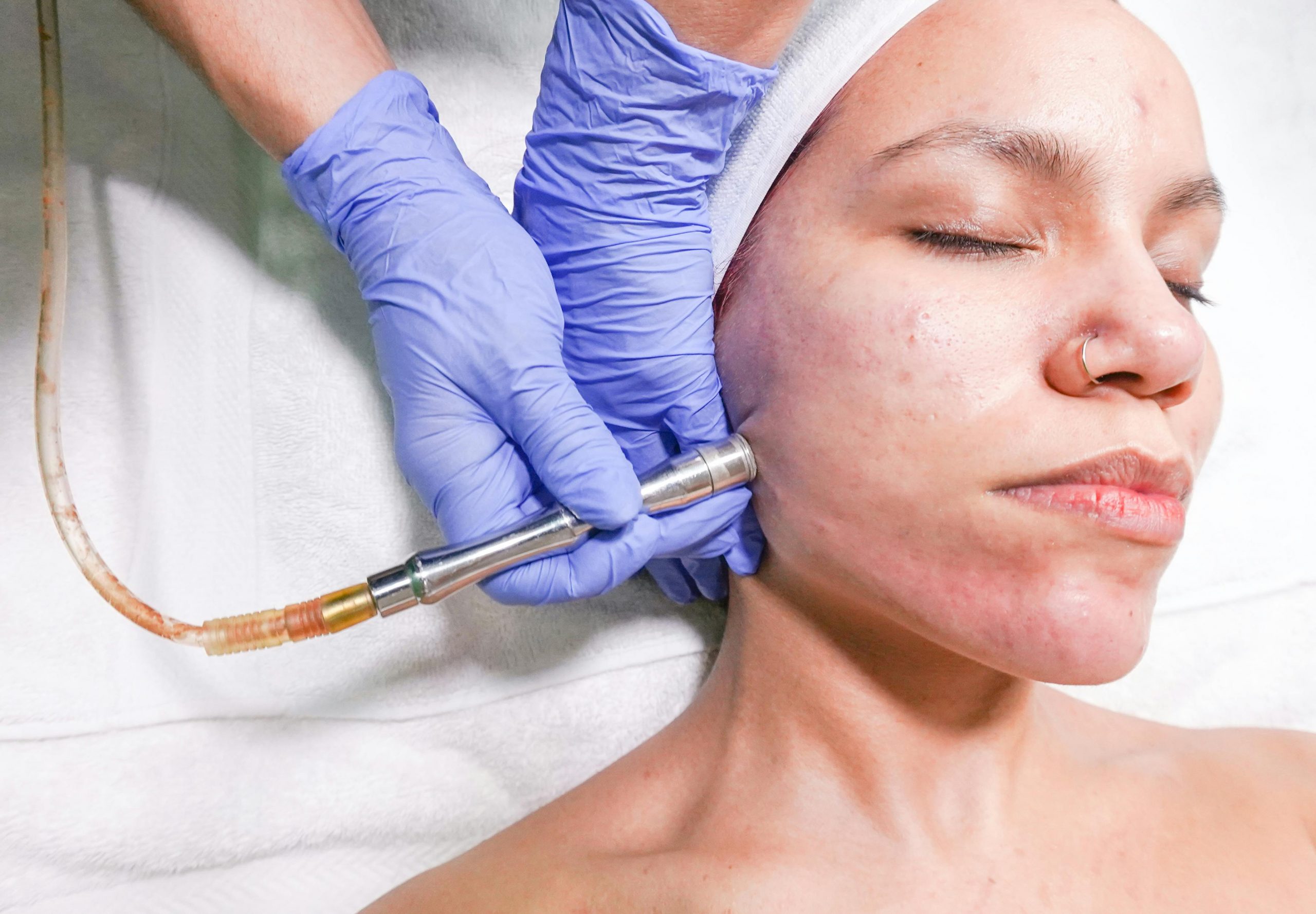 A woman receiving a microdermabrasion facial treatment by a professional with gloved hands.